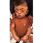 The fingers of each hand are fused together. Surgery will change his world.